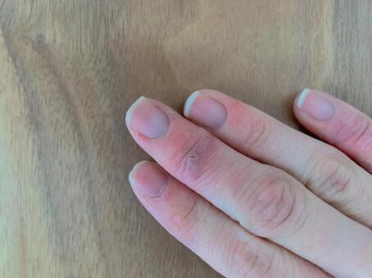 قضمة الصقيع وأسبابها ومضاعفاتها وعلاجها في المنزل