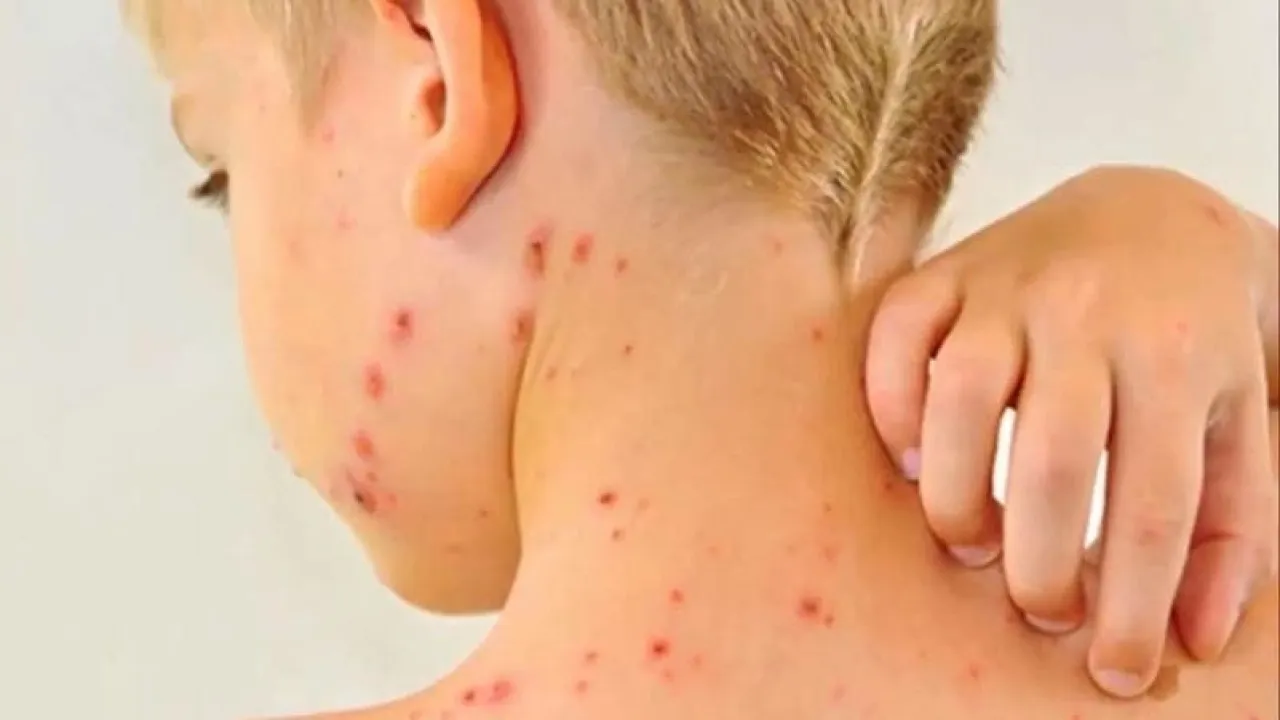 أميركا تشهد أكبر موجة تفشٍّ للحصبة خلال 10 سنوات