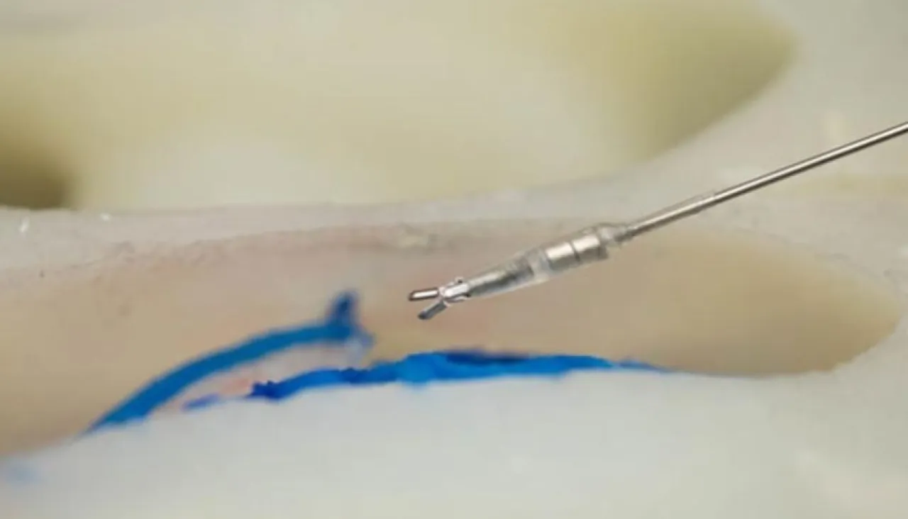 بنسبة نجاح 76 روبوتات دقيقة تنفذ جراحات الدماغ بدون مشرط