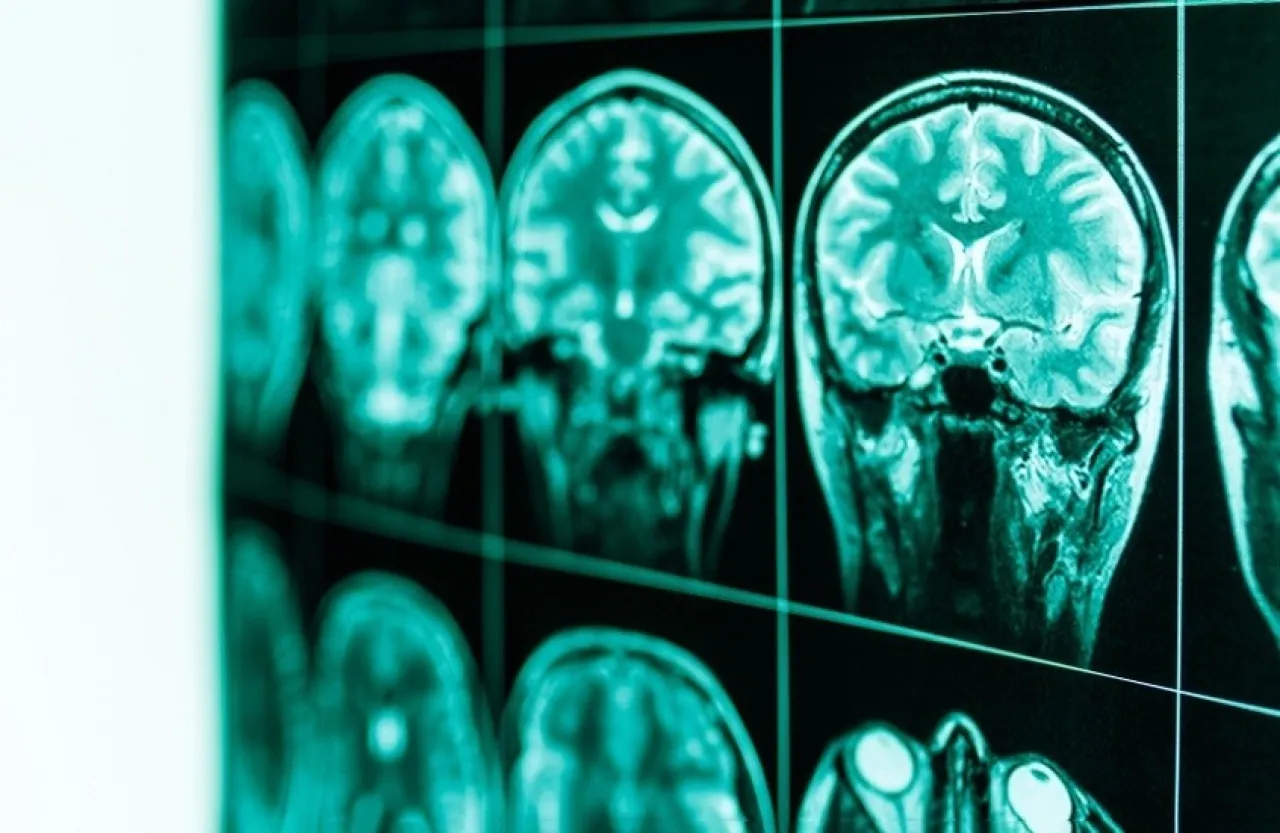 دراسة توضح تأثير الكحول على مناطق اتخاذ القرارات في الدماغ