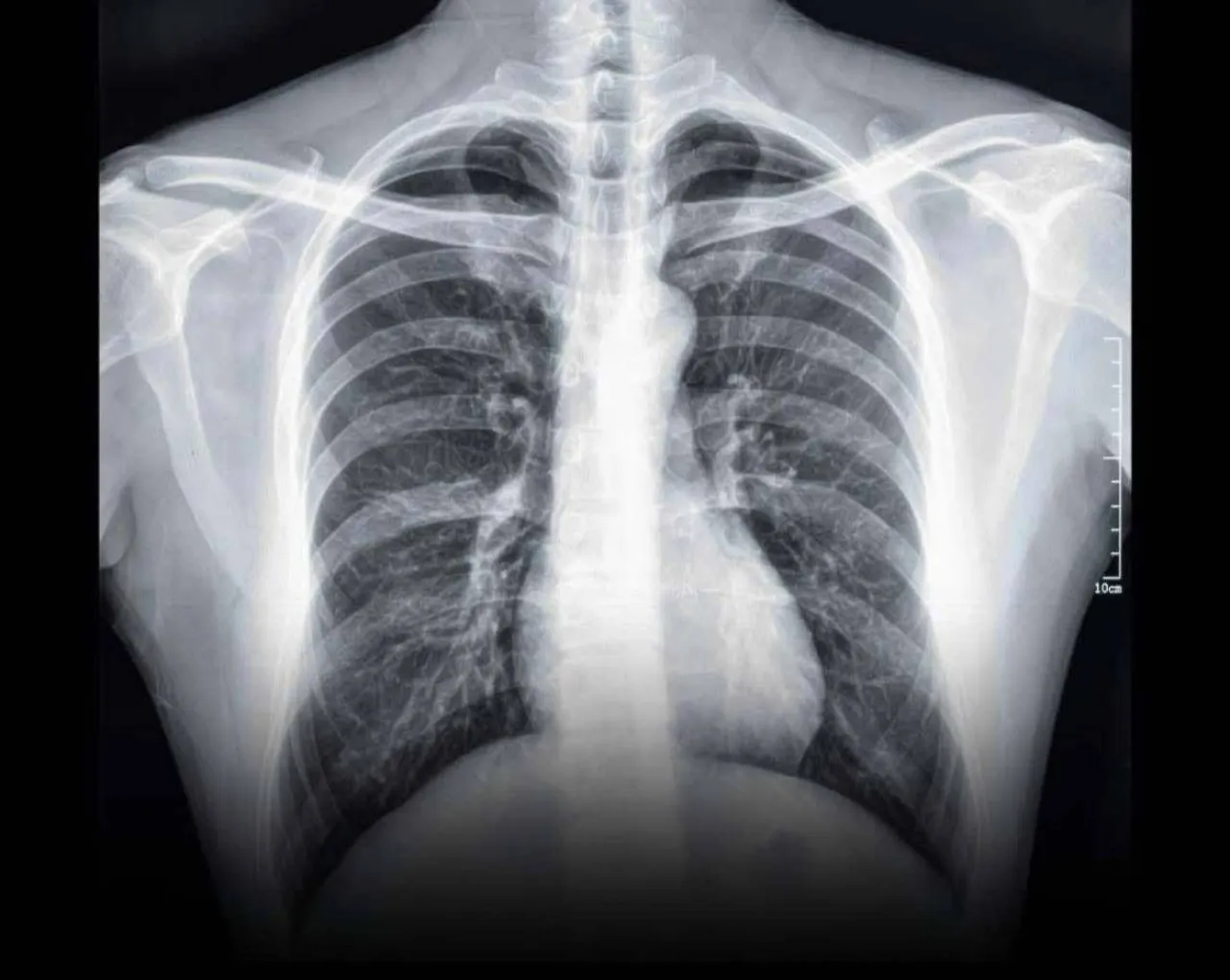 طبيبة تحذّر مراهق أردني يصاب بتليف رئوي دائم بسبب الفيب