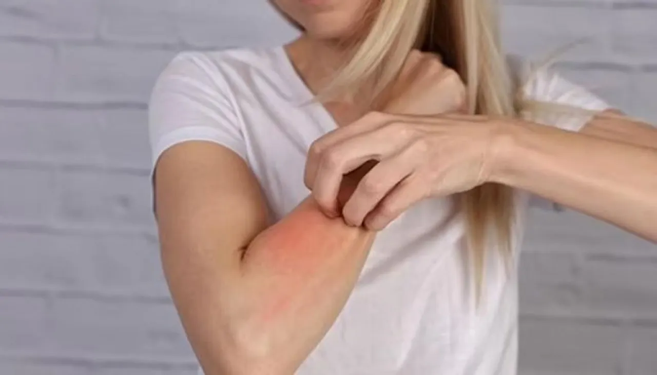 سن اليأس يفجر الإكزيما دراسة تكشف تأثير هرمونات النساء على الجلد