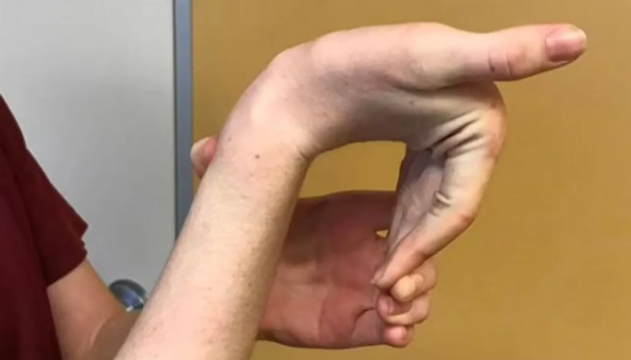 مرونة الأصابع الزائدة مؤشر على مخاطر صحية