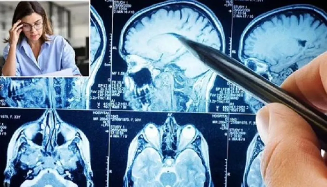 مخك تحت الضغط العمل المفرط يعيد تشكيل دماغك