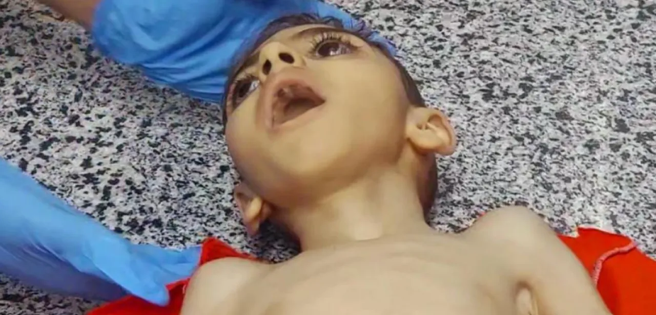 استشهاد طفل بغزة جراء سوء التغذية