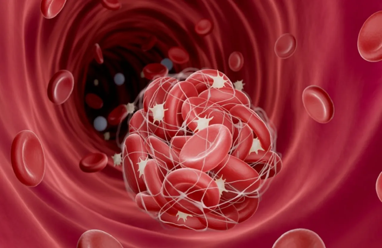 ثورة طبية جديدة تقنية مبتكرة لإزالة جلطات الدم بفعالية مذهلة