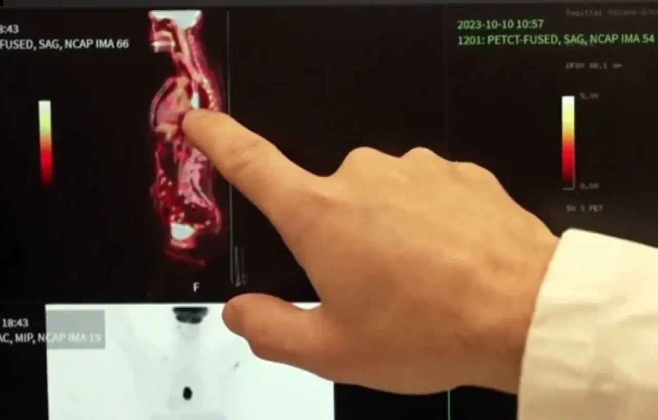 علاج جديد لتفتيت الخلايا السرطانية بالأشعة تحت الحمراء