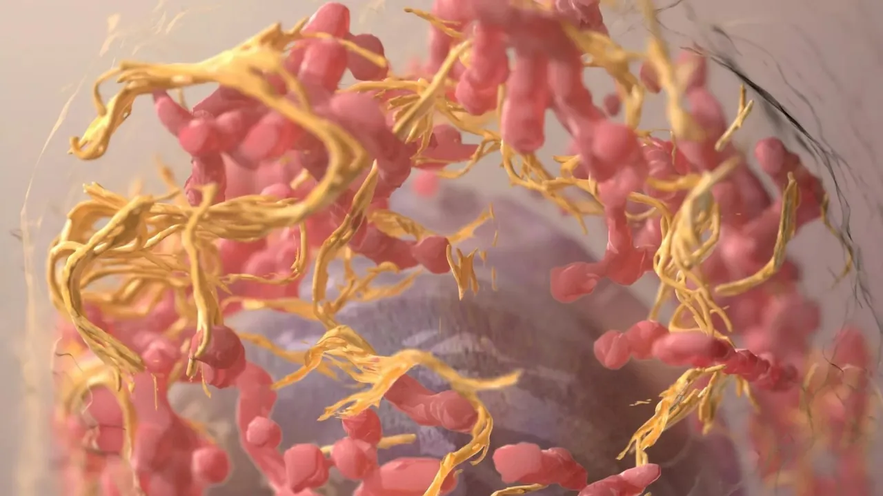 سرطان نادر يشهد انتشارا مفاجئا بين الشباب والخبراء في حيرة