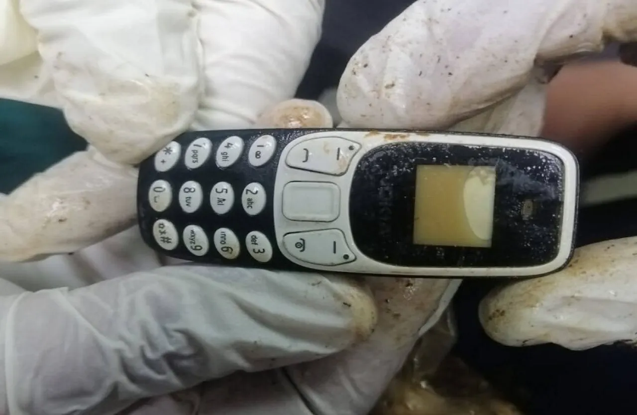 استخراج هاتف محمول من بطن شاب مصري بعد عامين من ابتلاعه