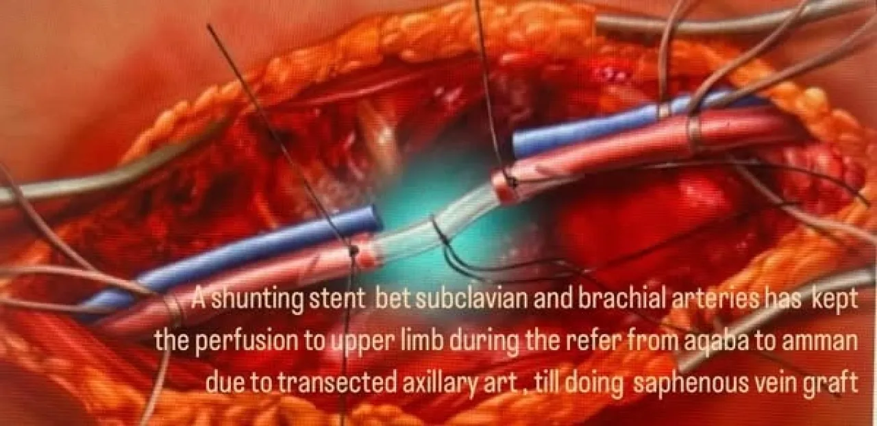 إنقاذ ذراع شاب بعملية دقيقة في مستشفى الأمير هاشم بالعقبة