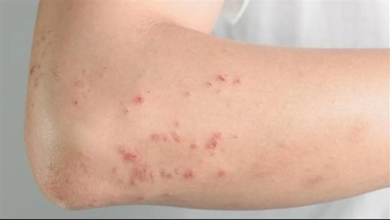 معلومات لا تعرفها عن مرض الانحلال الفقاعي