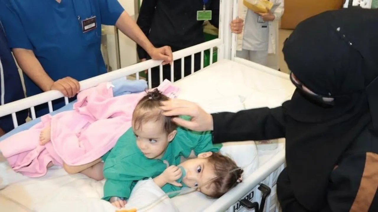 السعودية بدء عملية فصل التوأم الملتصقين السوريين سيلين وإيلين