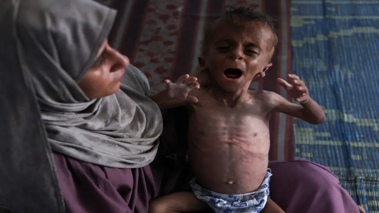 وفاة 5 فلسطينيين بينهم طفلان خلال 24 ساعة بسبب سوء التغذية بغزة