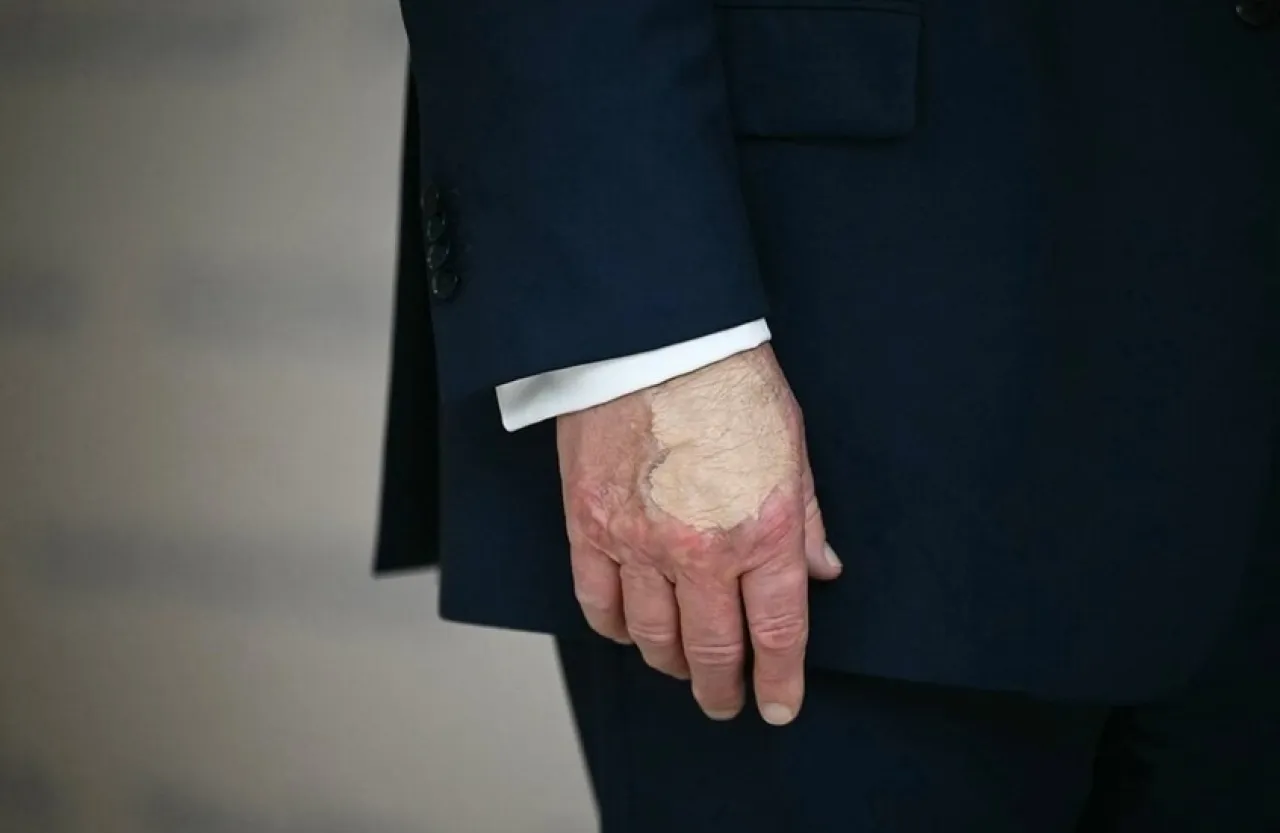 كدمة جديدة على يد ترمب تثير التكهنات مجددا حول صحته