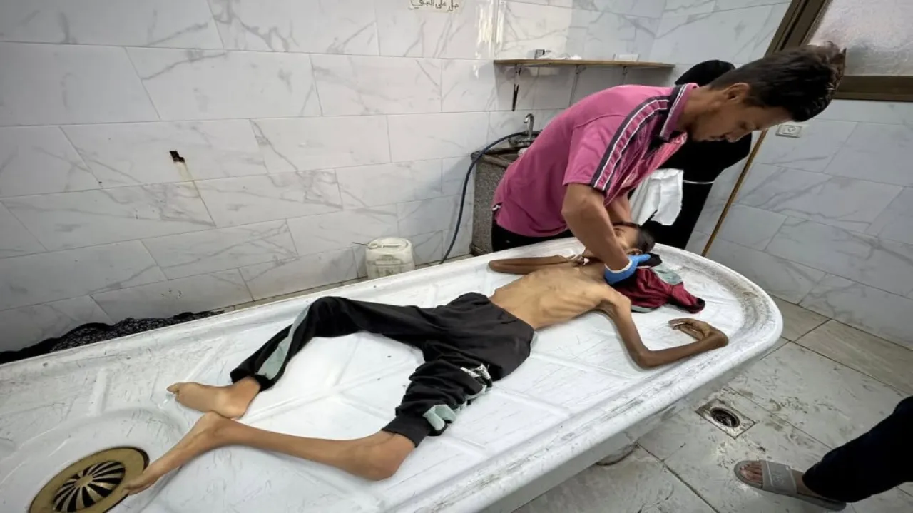 10 شهداء في غزة نتيجة المجاعة وسوء التغذية