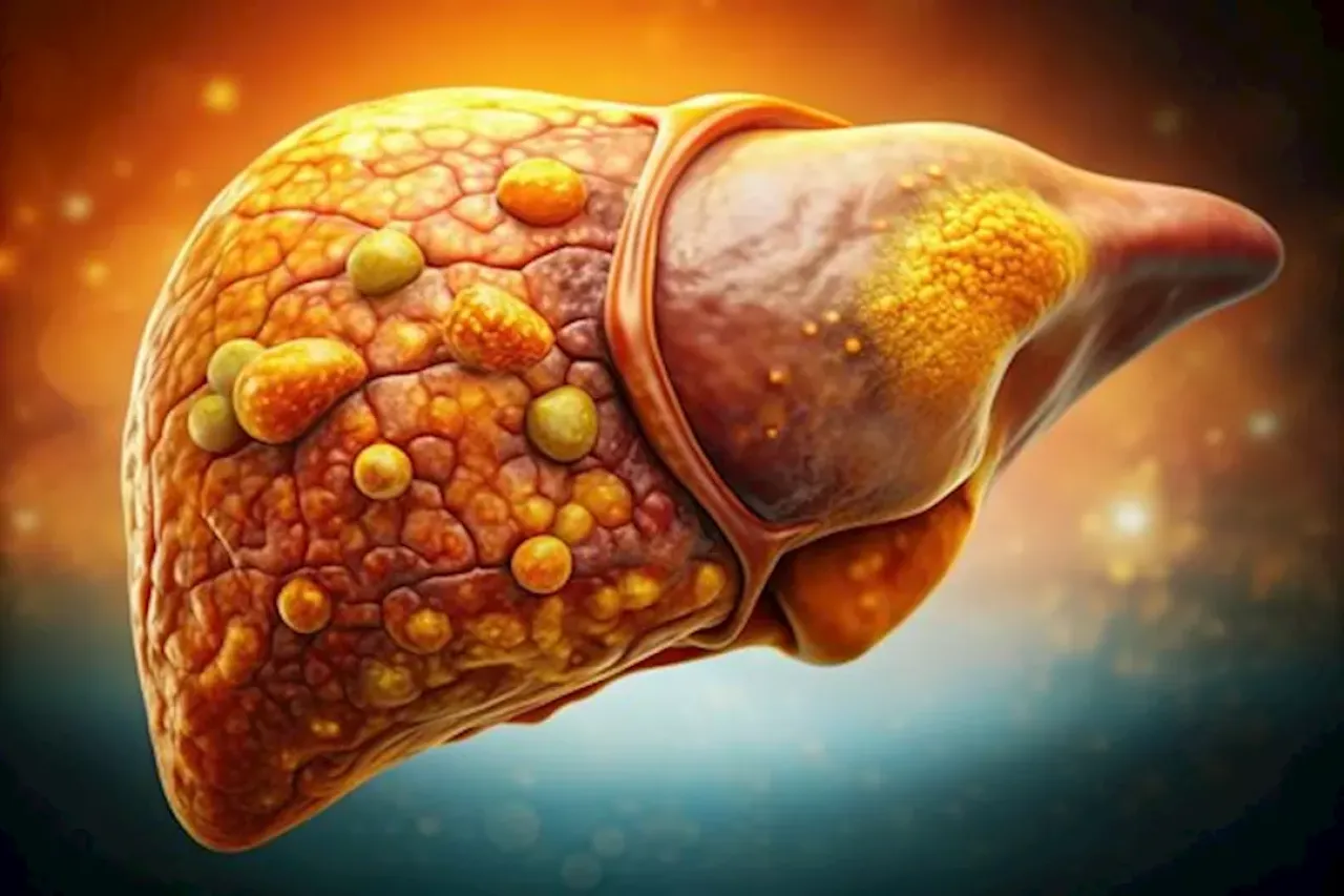 في أقل من شهر طبيب يكشف طريقة لعلاج مرض الكبد الدهني