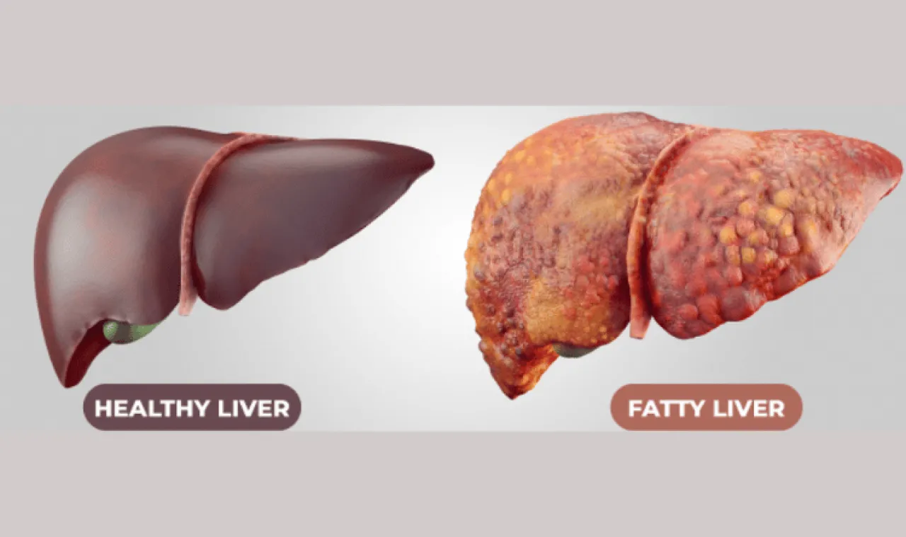 الكبد الدهني غير الكحولي MASLD قد يهدد صحتكِ  تعرفوا عليه