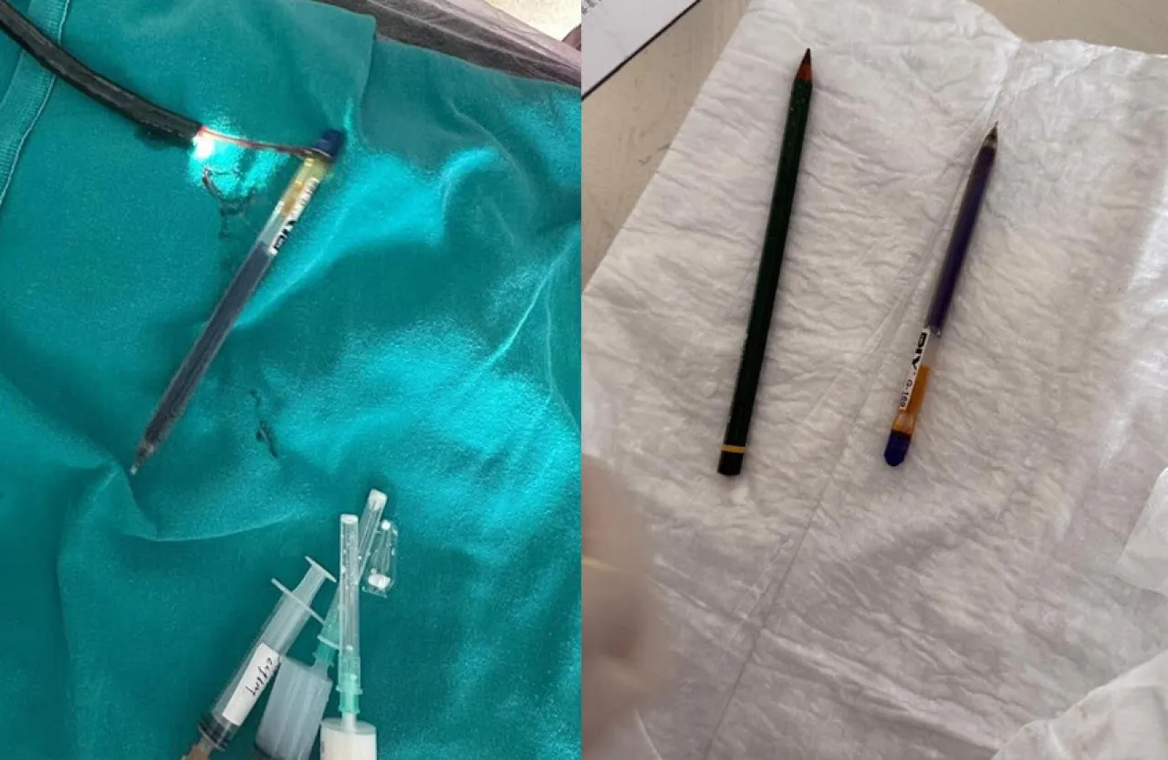 بسبب اضطراب نادر استخراج قلمين من معدة شابة تركية صور