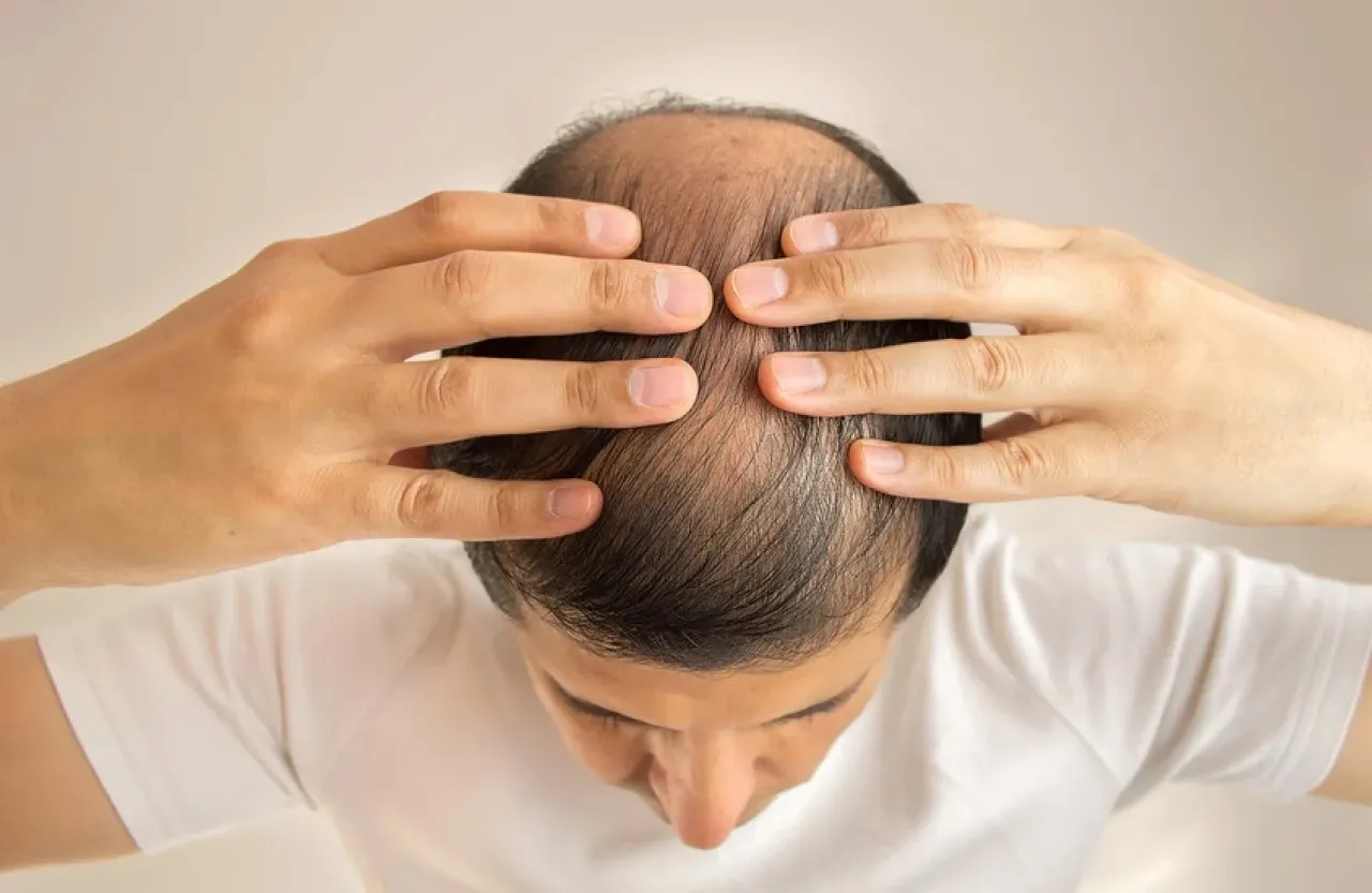 A Natural Element That Doubles the Results of a Common Baldness Treatment What is it