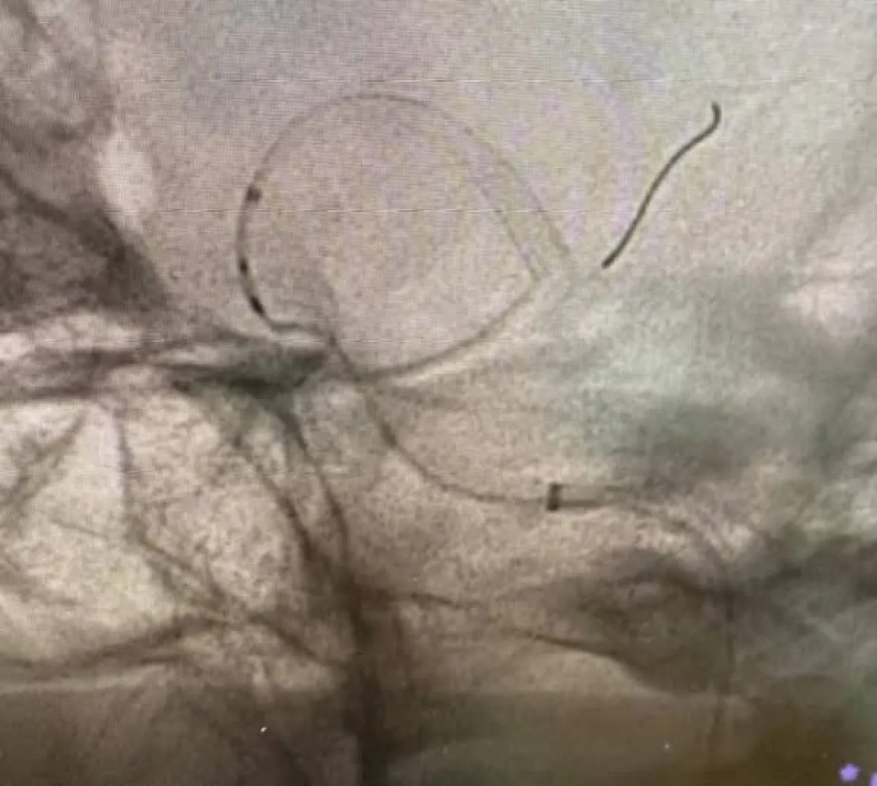 عملية دقيقة تنقذ حياة مريض من نزيف دماغي حاد في مستشفى الملك المؤسس