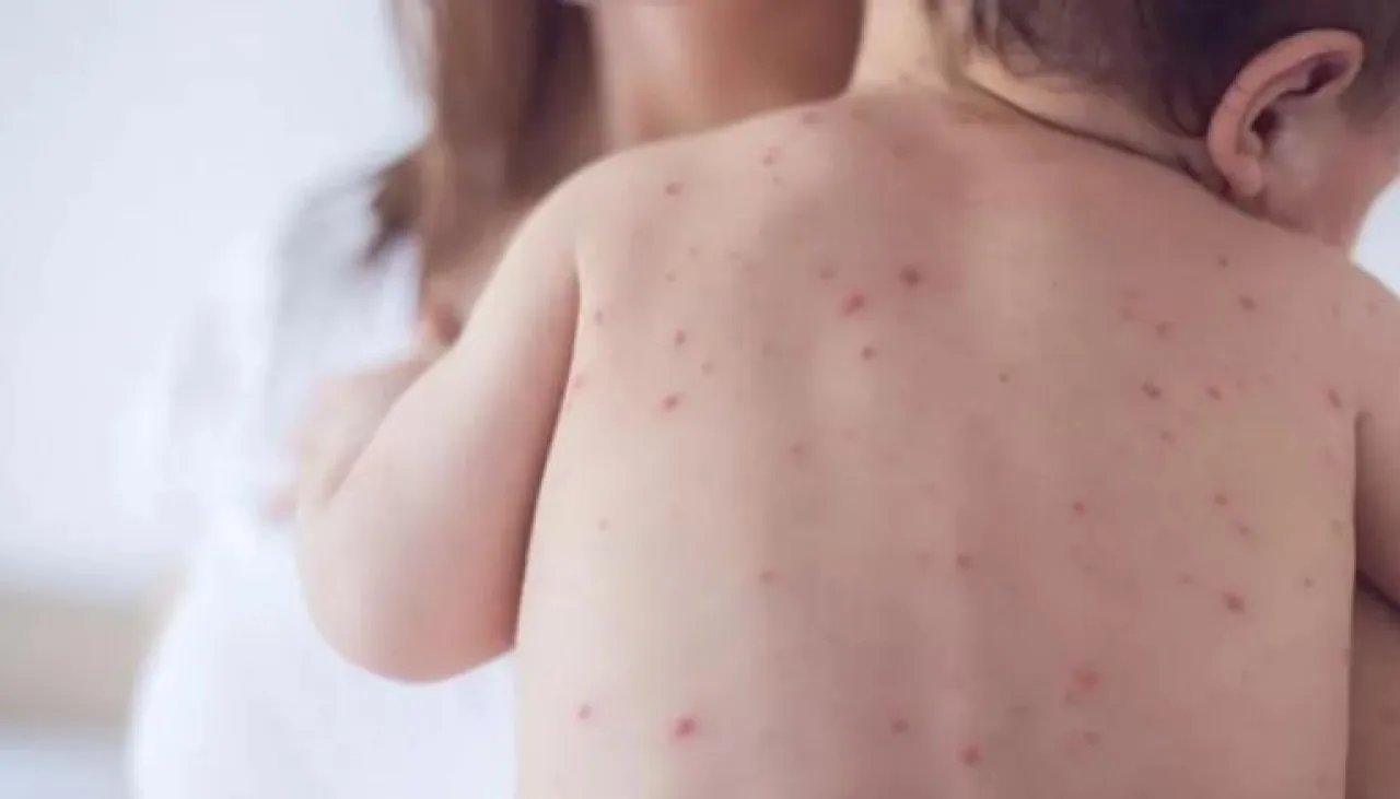 أعلى حصيلة منذ 30 عاما  الحصبة تجتاح أمريكا