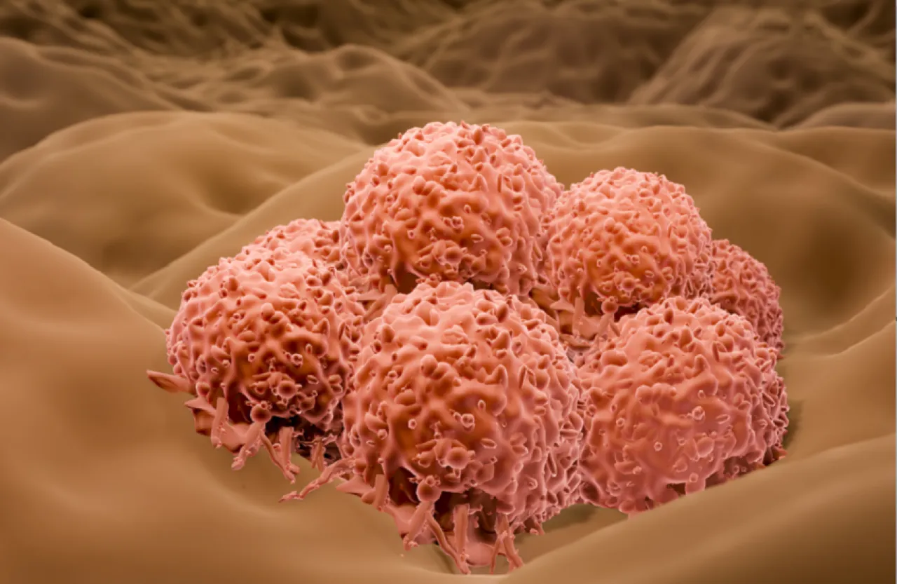 رقعة ذكية جديدة تكشف سرطان الجلد بدون تدخل جراحي