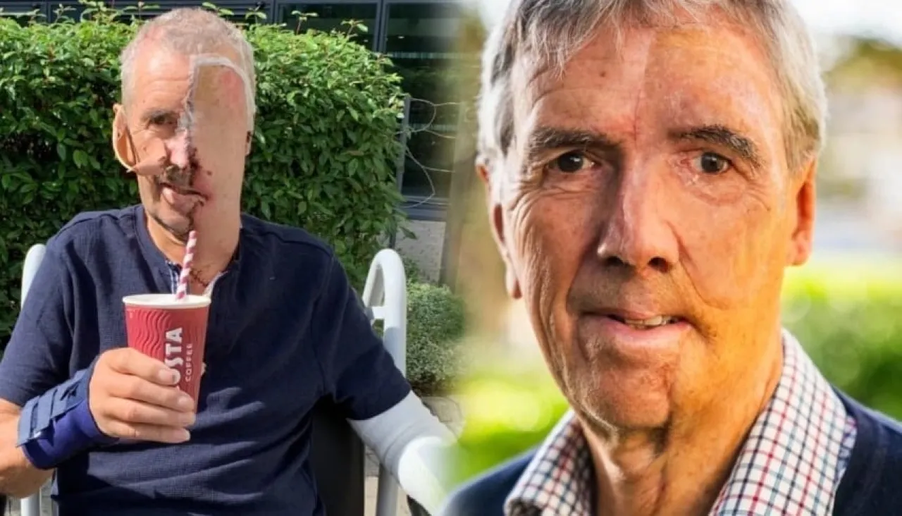 بعد حادث مروع بريطاني يحصل على أول وجه مطبوع بتقنية ثلاثية الأبعاد