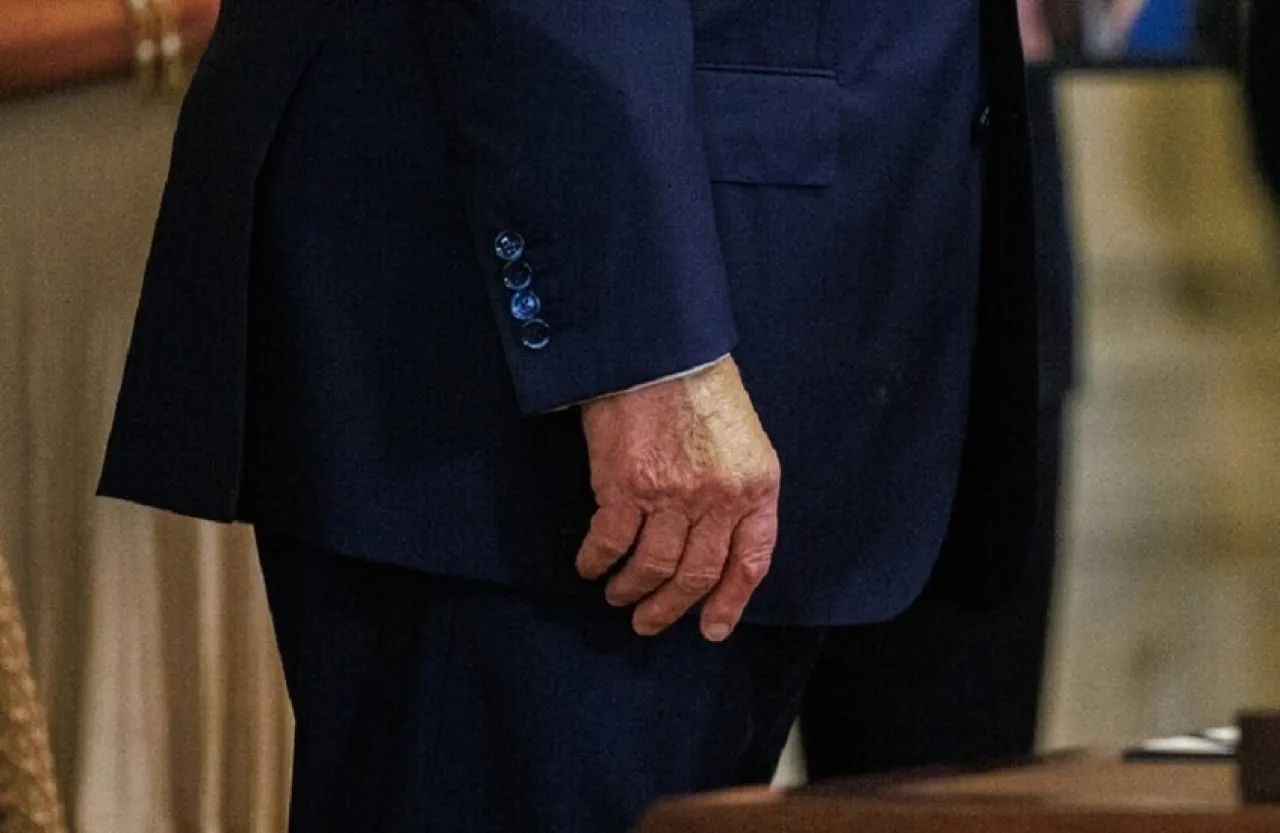 Trump Covers Up Blue Bruise on His Hand Using Makeup Again