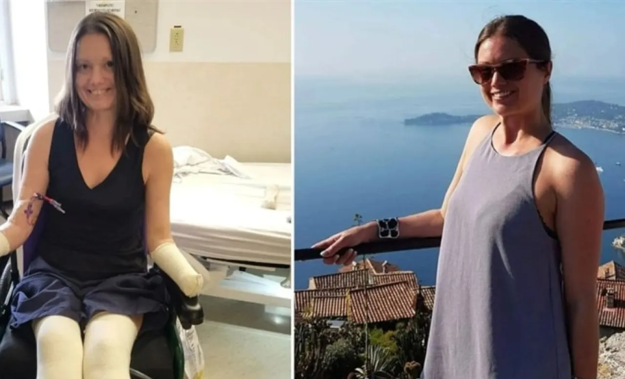 Minor jaw pain ends tragically with the amputation of a girls hands and feet