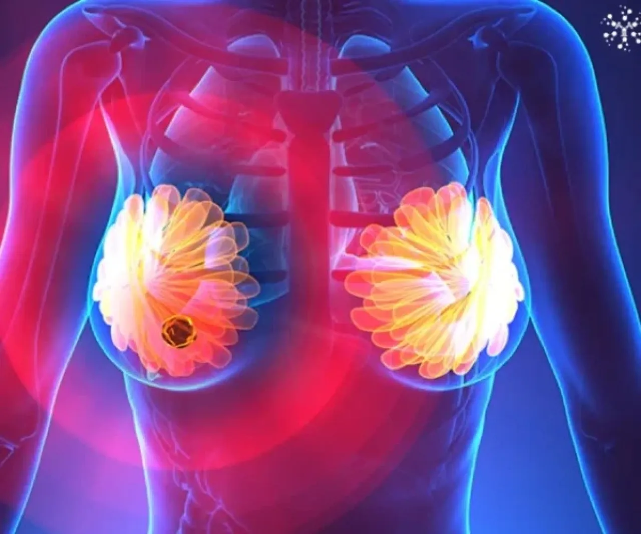 دواء جديد يعزز فرص السيطرة على سرطان الثدي المتقدم