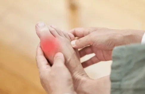 The Real Source of Gout