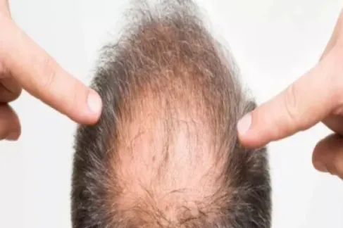 New Medical Breakthrough.. First Topical Treatment for Baldness Regrows Hair