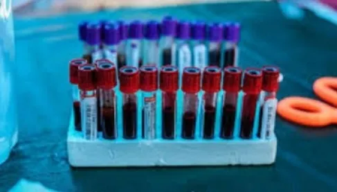 مفاجأة علمية.. اختبار دم يكشف سرطان الرئة من خلية واحدة