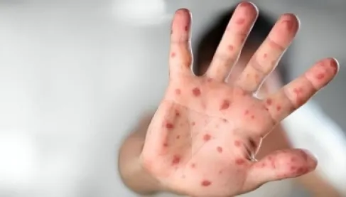 الحصبة تنتشر مجددا عالميا رغم انخفاض الوفيات منذ عام 2000