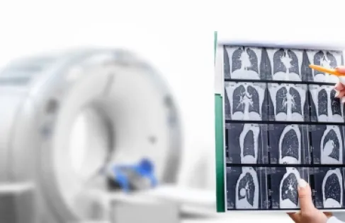 آلية جديدة تفسر شراسة سرطان الخلايا الصغيرة في الرئة