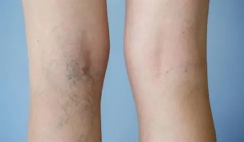 طريقة للوقاية من تطور الدوالي