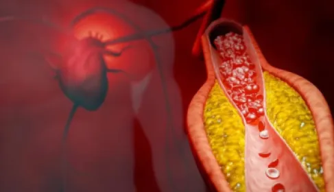 3 طرق لخفض الكوليسترول بدون أدوية ستاتين