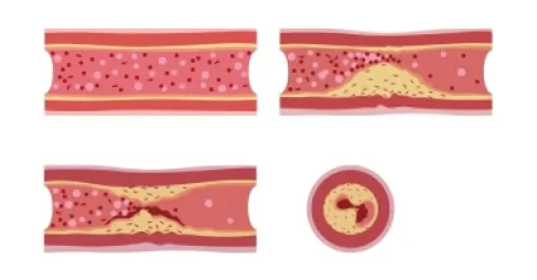 كيف يحمي التشخيص المبكر من تصلب الشرايين؟