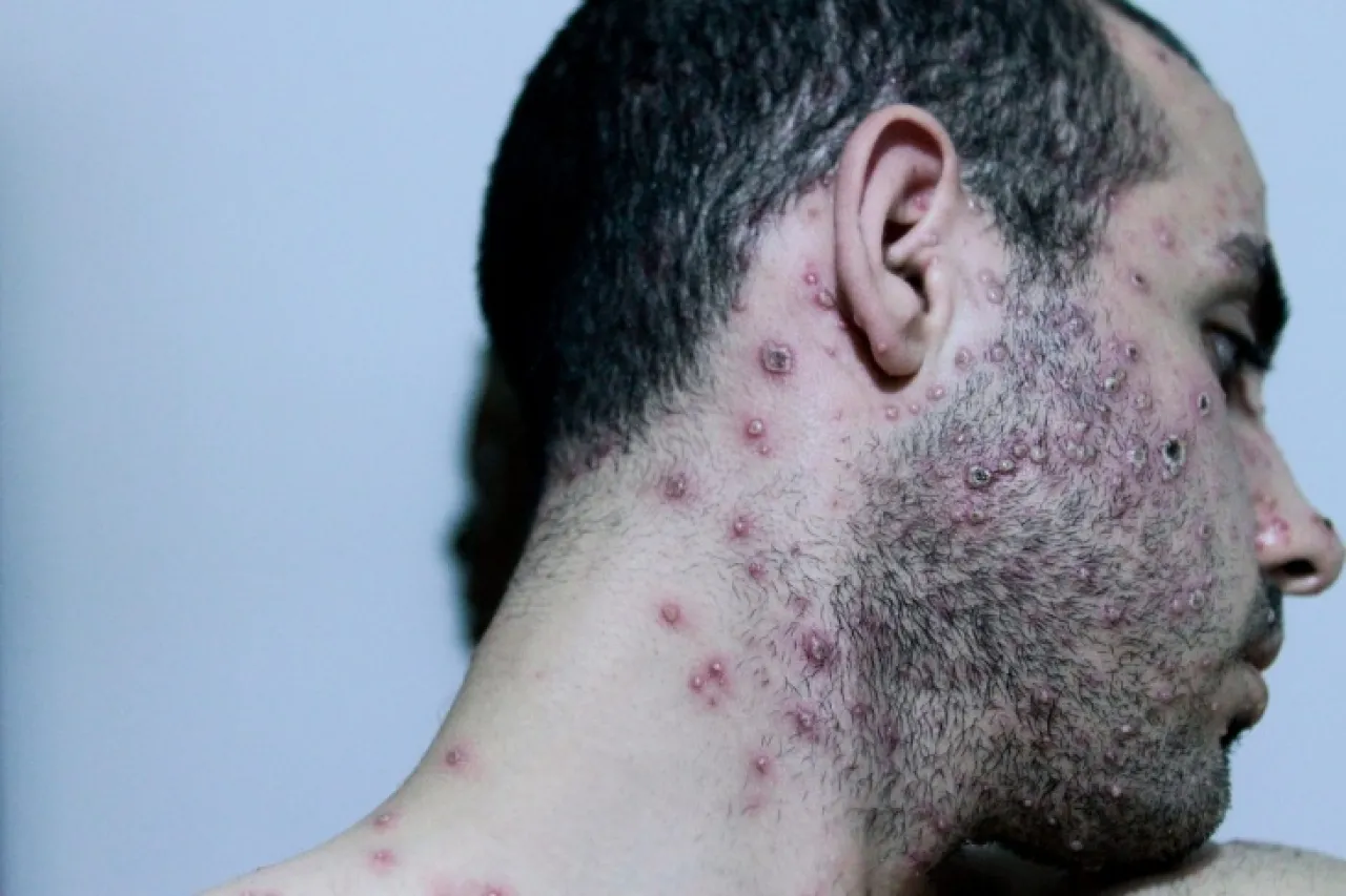 الصحة الاسرائيلية تعلن تسجيل أول حالة بجدري القرود #عاجل 