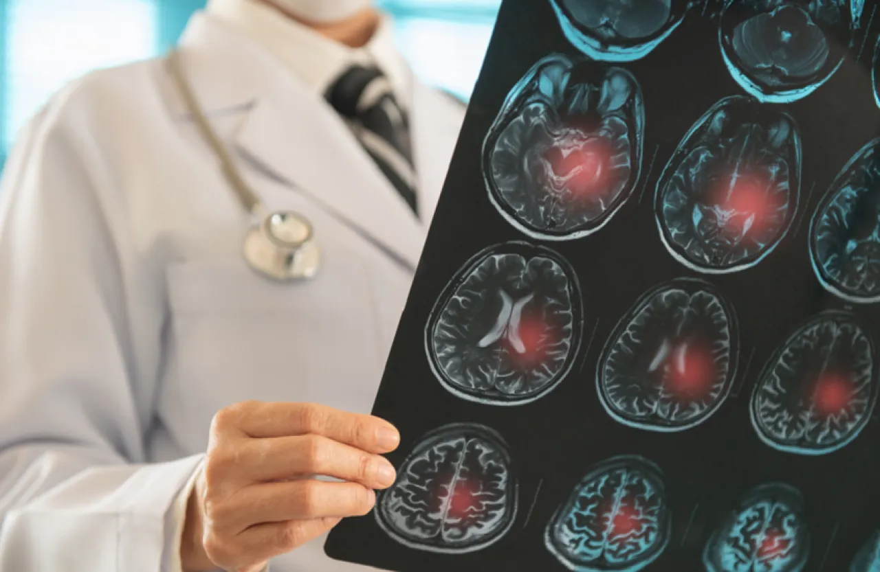 جهاز مبتكر يعيد النطق لمرضى السكتة الدماغية 