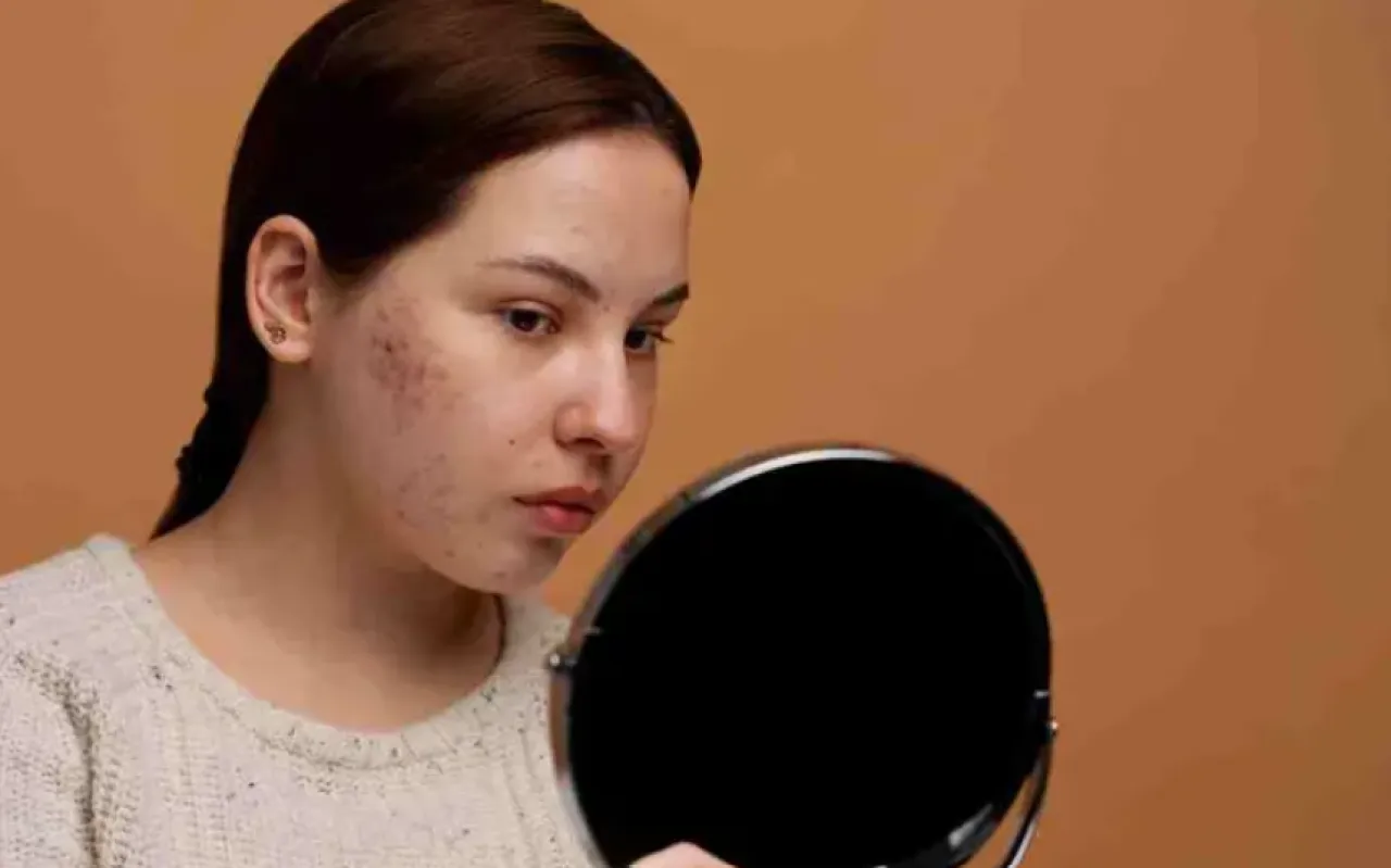 حب الشباب في الشتاء.. لماذا يكثر وكيف نتخلص منه؟ 