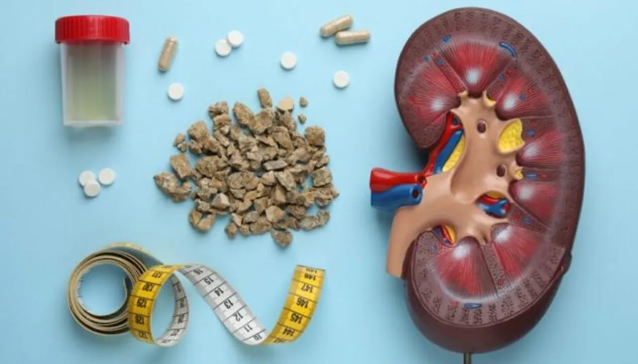 مفاجأة علمية: بكتيريا تشارك في تكوين حصوات الكلى 