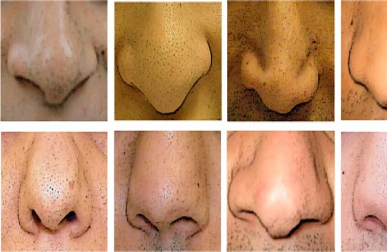 لماذا لا يوجد (أنف مثالي) يناسب الجميع؟ 