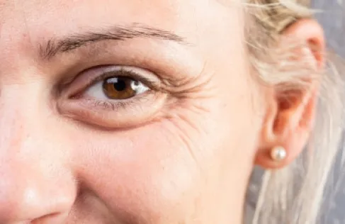 كيف تكشف تجاعيد العينين أسرار صحة الدماغ