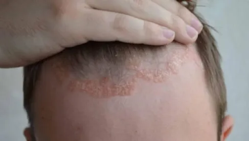 دواء مناعي يمنع عودة الصدفية