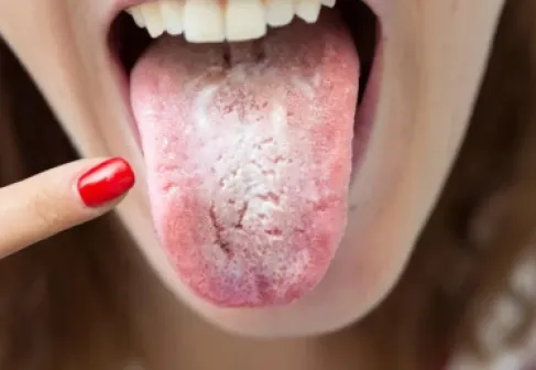 الذكاء الاصطناعي يشخّص السكري وسرطان المعدة من لون اللسان