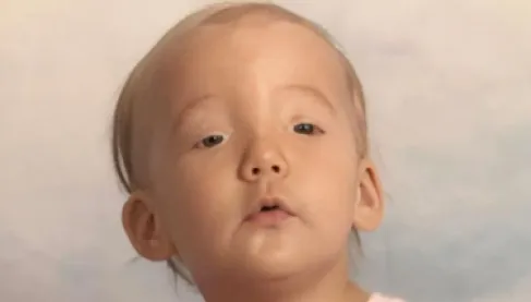 الفتاة التي لا ترمش.. قصة تكشف معاناة مصابي متلازمة «تدلّي الجفن الخلقي»