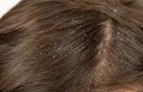 قشرة الرأس وأسبابها المتنوعة وكيفية التعامل معها بفعالية