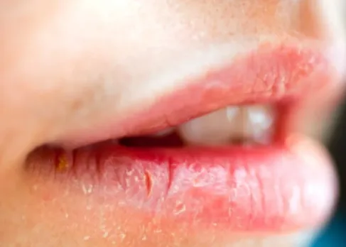 تشققات الشفاه المستمرة قد تشير إلى هذا المرض