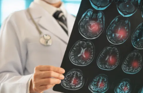 جهاز مبتكر يعيد النطق لمرضى السكتة الدماغية